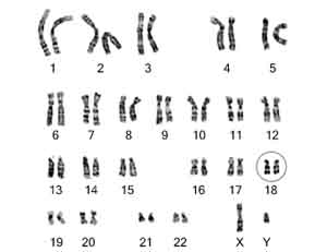 Chromosome abnormality